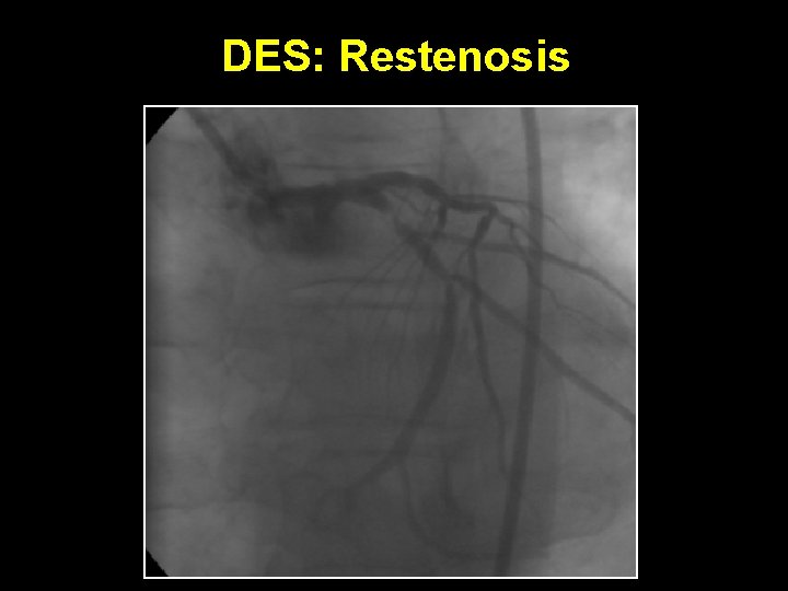 DES: Restenosis 