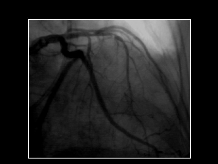 Coronary Dissection 