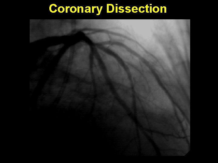 Coronary Dissection 