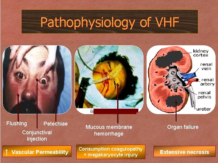 Pathophysiology of VHF Flushing Petechiae Conjunctival injection ↑ Vascular Permeability Mucous membrane hemorrhage Consumption