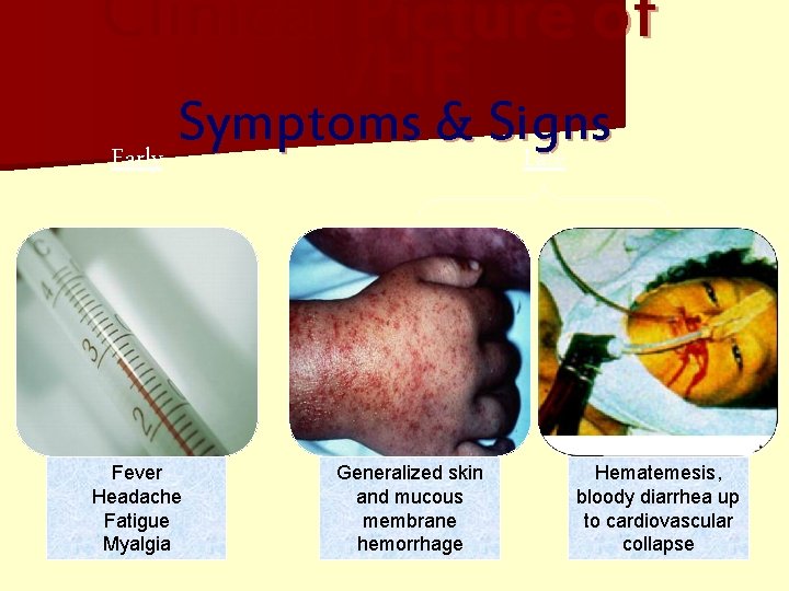 Clinical Picture of VHF Symptoms & Signs Early Late Fever Headache Fatigue Myalgia Generalized