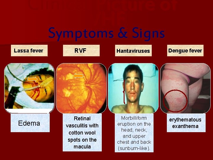 Clinical Picture of VHF Symptoms & Signs Lassa fever Edema RVF Retinal vasculitis with