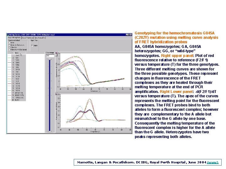 Genotyping for the hemochromatosis G 845 A (C 282 Y) mutation using melting curve