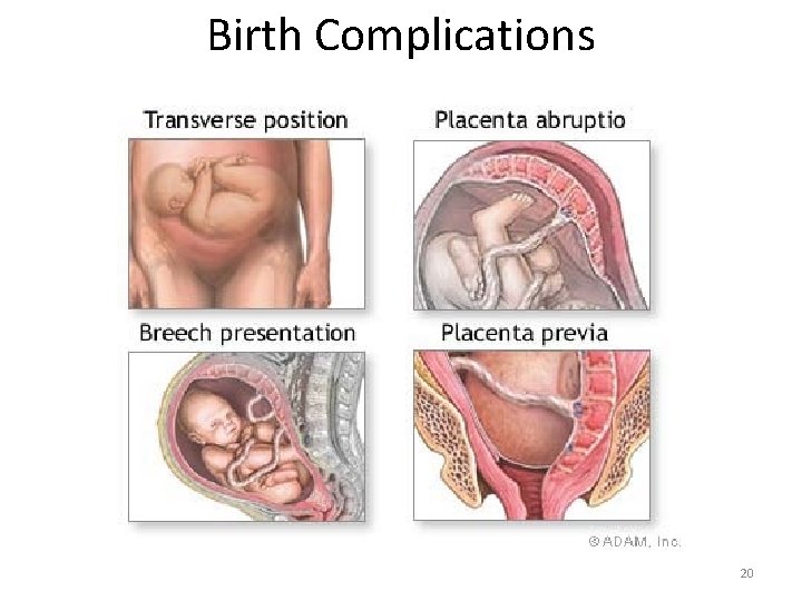 Birth Complications Copyright © Houghton Mifflin Harcourt Publishing Company. All rights reserved. 20 
