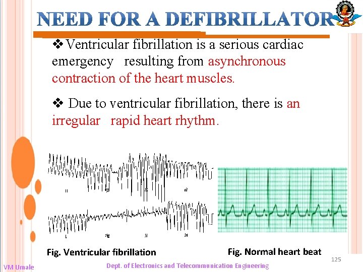 v. Ventricular fibrillation is a serious cardiac emergency resulting from asynchronous contraction of the
