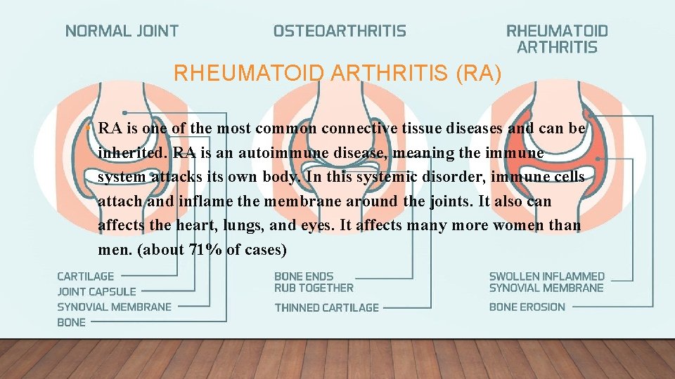 RHEUMATOID ARTHRITIS (RA) • RA is one of the most common connective tissue diseases