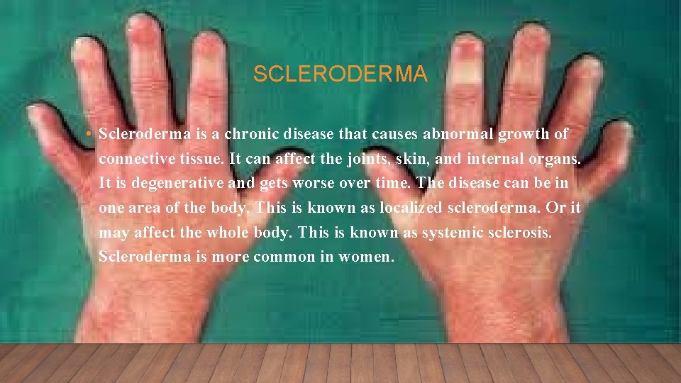 SCLERODERMA • Scleroderma is a chronic disease that causes abnormal growth of connective tissue.