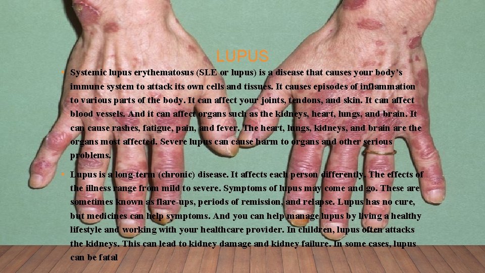 LUPUS • Systemic lupus erythematosus (SLE or lupus) is a disease that causes your