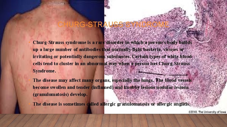 CHURG-STRAUSS SYNDROME • Churg-Strauss syndrome is a rare disorder in which a person's body