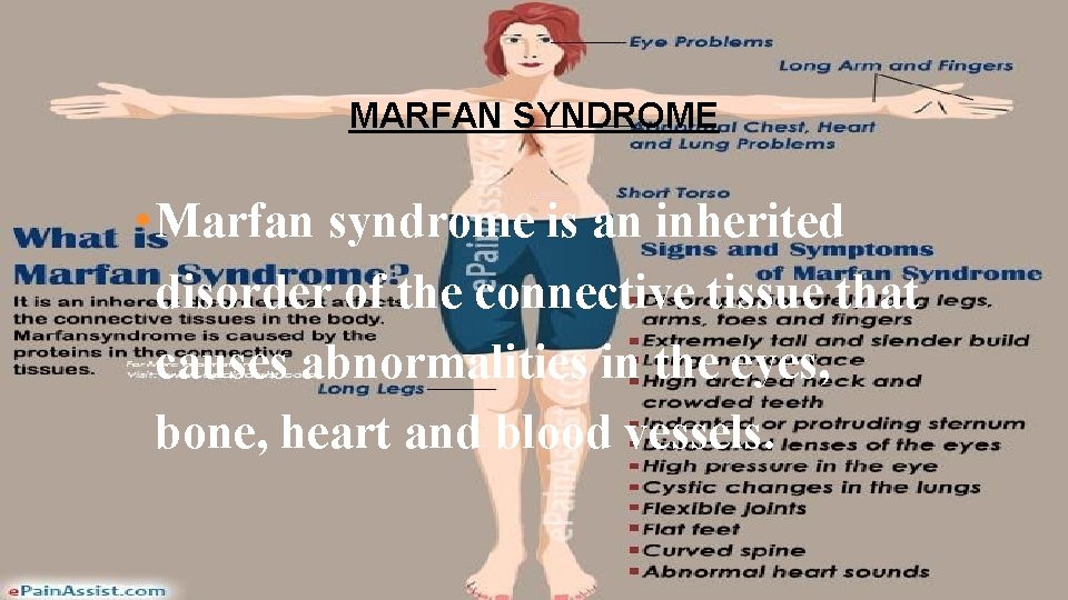 MARFAN SYNDROME • Marfan syndrome is an inherited disorder of the connective tissue that