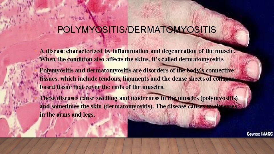 POLYMYOSITIS/DERMATOMYOSITIS • A disease characterized by inflammation and degeneration of the muscle. When the