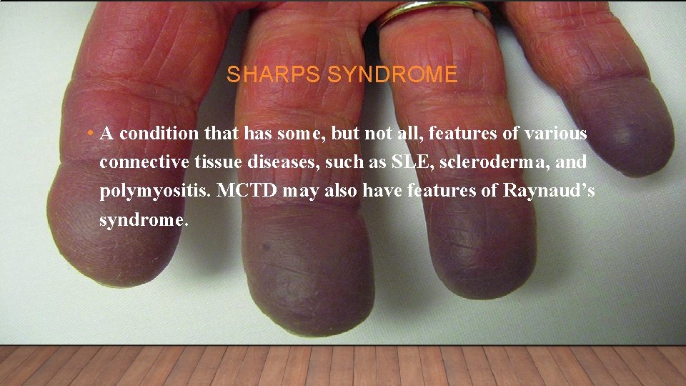SHARPS SYNDROME • A condition that has some, but not all, features of various