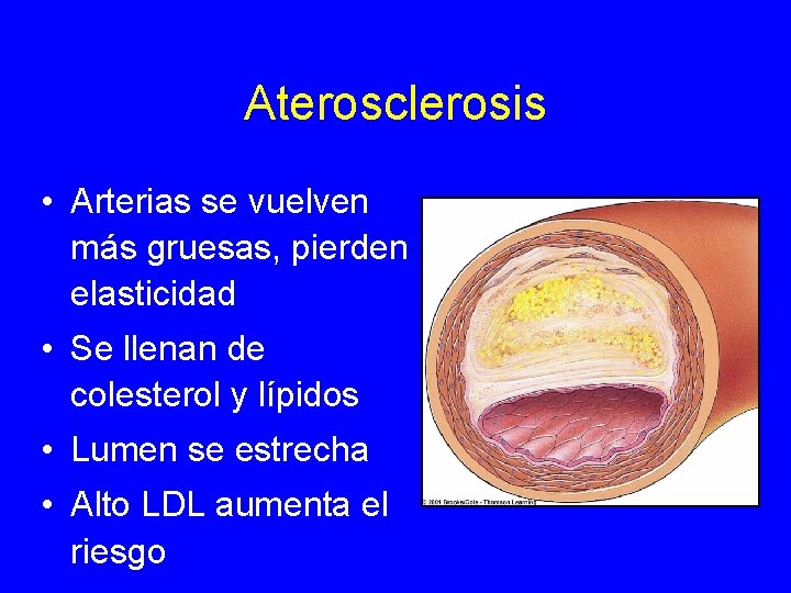 Aterosclerosis • Arterias se vuelven más gruesas, pierden elasticidad • Se llenan de colesterol