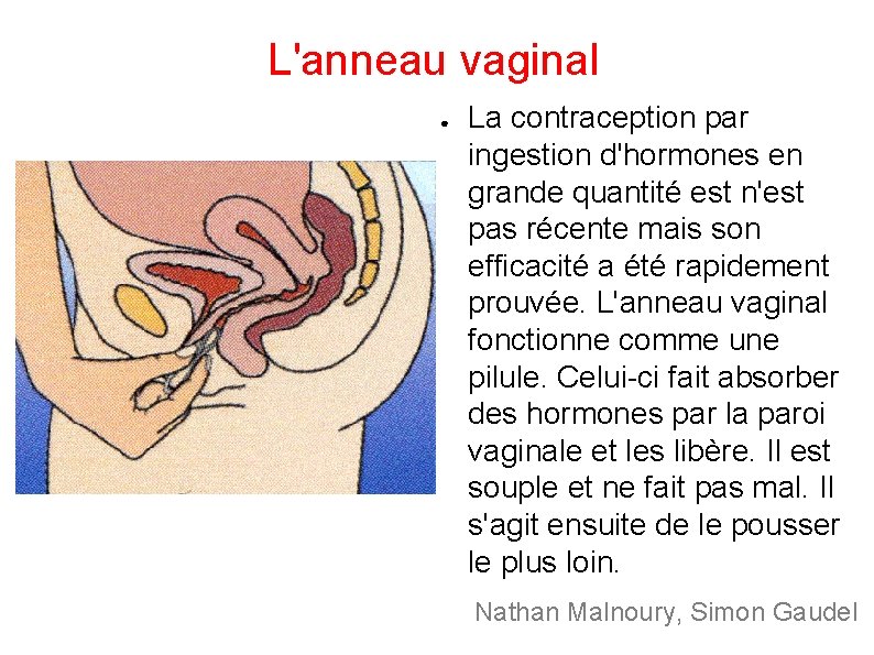 L'anneau vaginal ● La contraception par ingestion d'hormones en grande quantité est n'est pas L'anneau vaginal ● La contraception par ingestion d'hormones en grande quantité est n'est pas