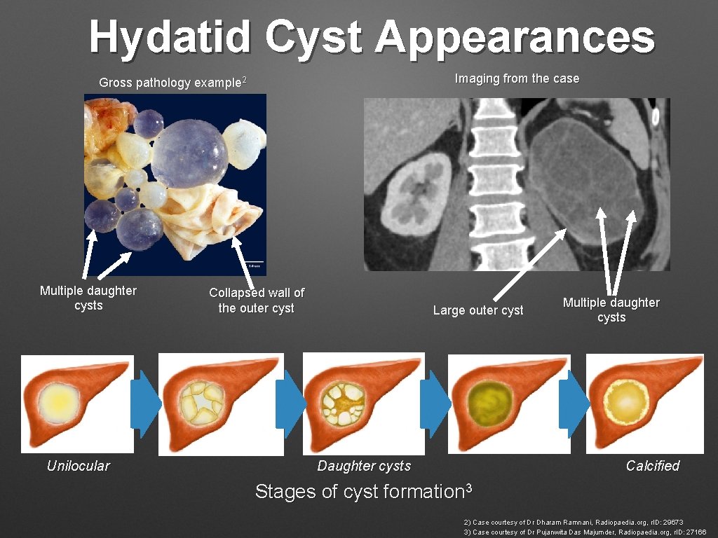 Hydatid Cyst Appearances Imaging from the case Gross pathology example 2 Multiple daughter cysts