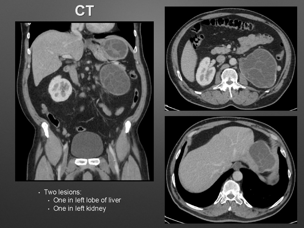 CT • Two lesions: • One in left lobe of liver • One in