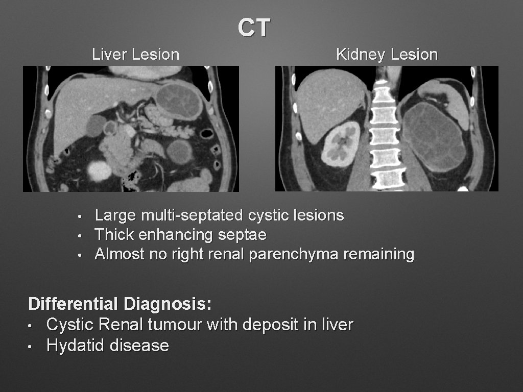 CT Liver Lesion • • • Kidney Lesion Large multi-septated cystic lesions Thick enhancing