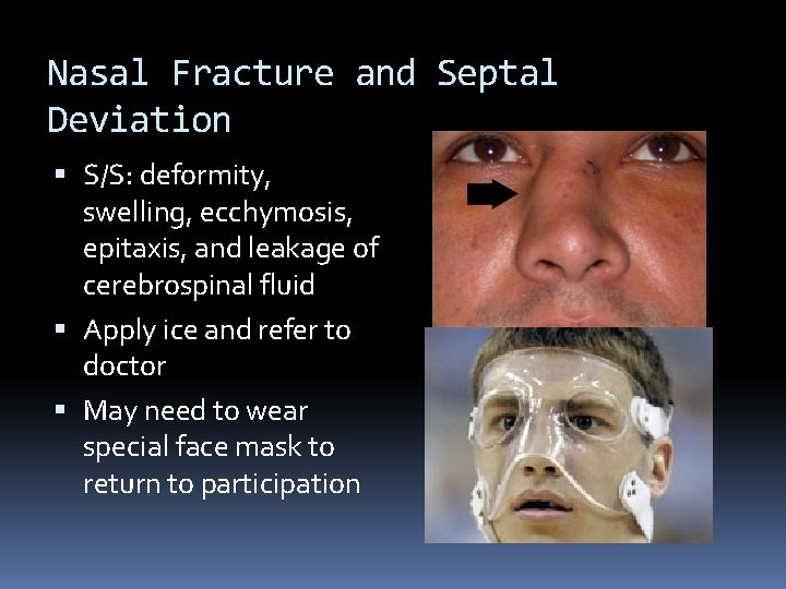 Nasal Fracture and Septal Deviation S/S: deformity, swelling, ecchymosis, epitaxis, and leakage of cerebrospinal