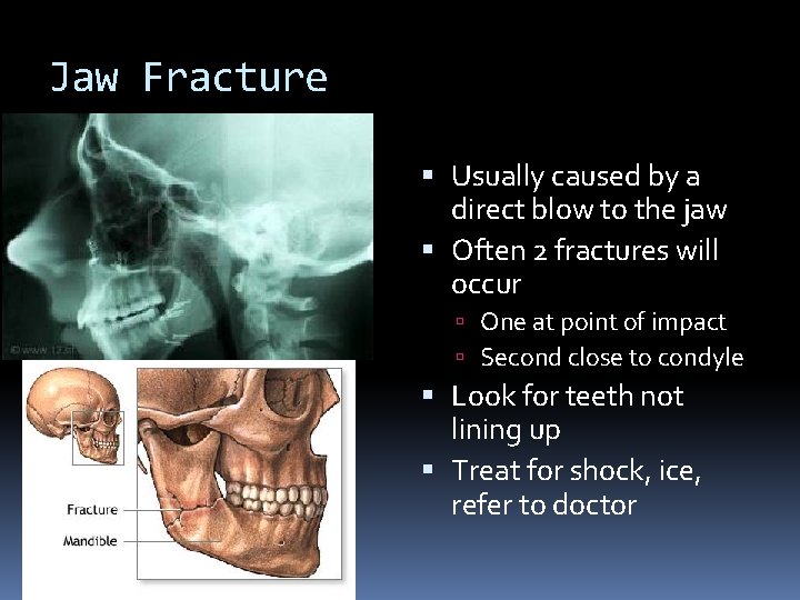 Jaw Fracture Usually caused by a direct blow to the jaw Often 2 fractures