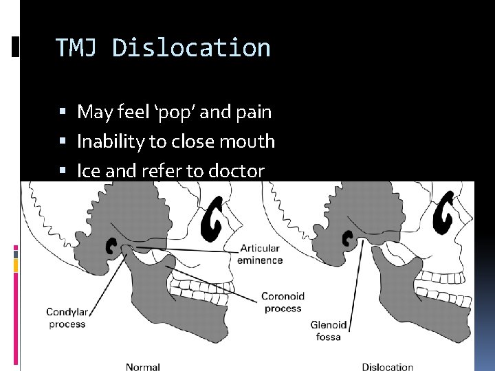 TMJ Dislocation May feel ‘pop’ and pain Inability to close mouth Ice and refer