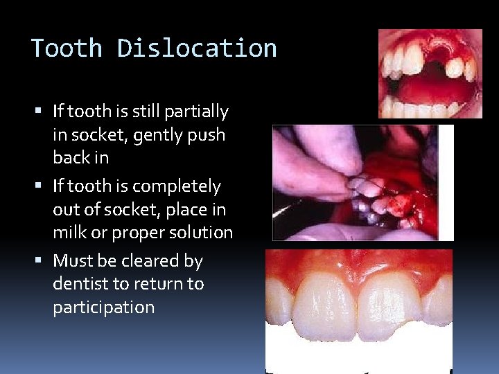 Tooth Dislocation If tooth is still partially in socket, gently push back in If