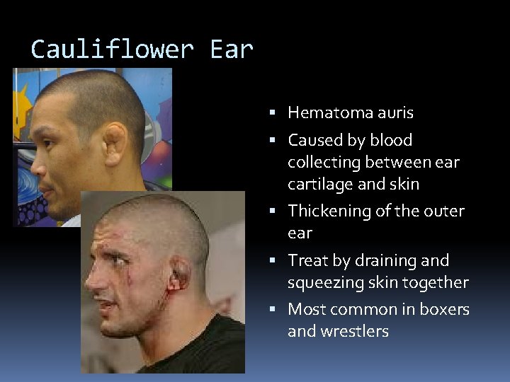 Cauliflower Ear Hematoma auris Caused by blood collecting between ear cartilage and skin Thickening