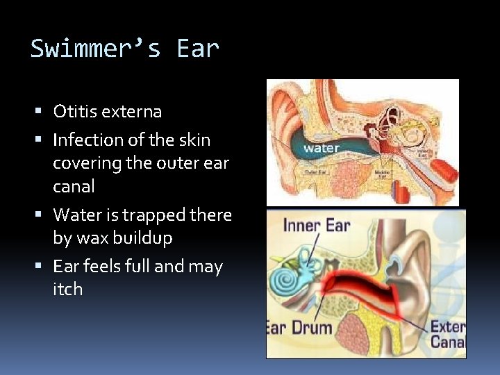 Swimmer’s Ear Otitis externa Infection of the skin covering the outer ear canal Water
