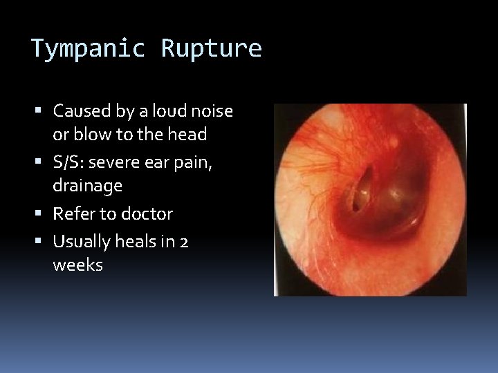 Tympanic Rupture Caused by a loud noise or blow to the head S/S: severe
