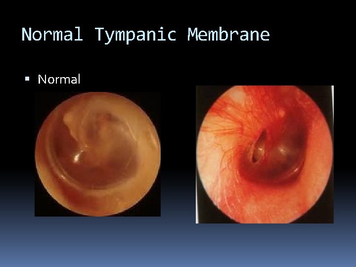 Normal Tympanic Membrane Normal 