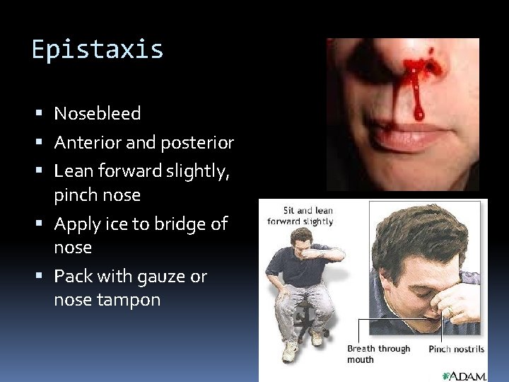 Epistaxis Nosebleed Anterior and posterior Lean forward slightly, pinch nose Apply ice to bridge