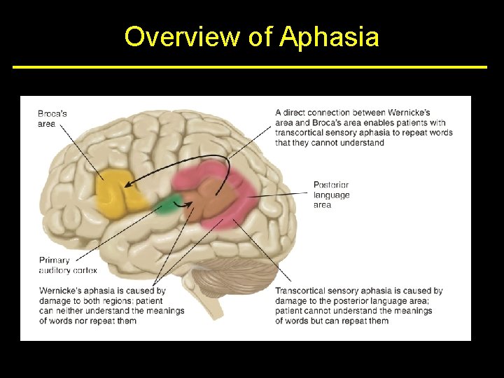 Overview of Aphasia 