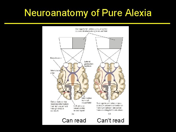 Neuroanatomy of Pure Alexia Can read Can’t read 