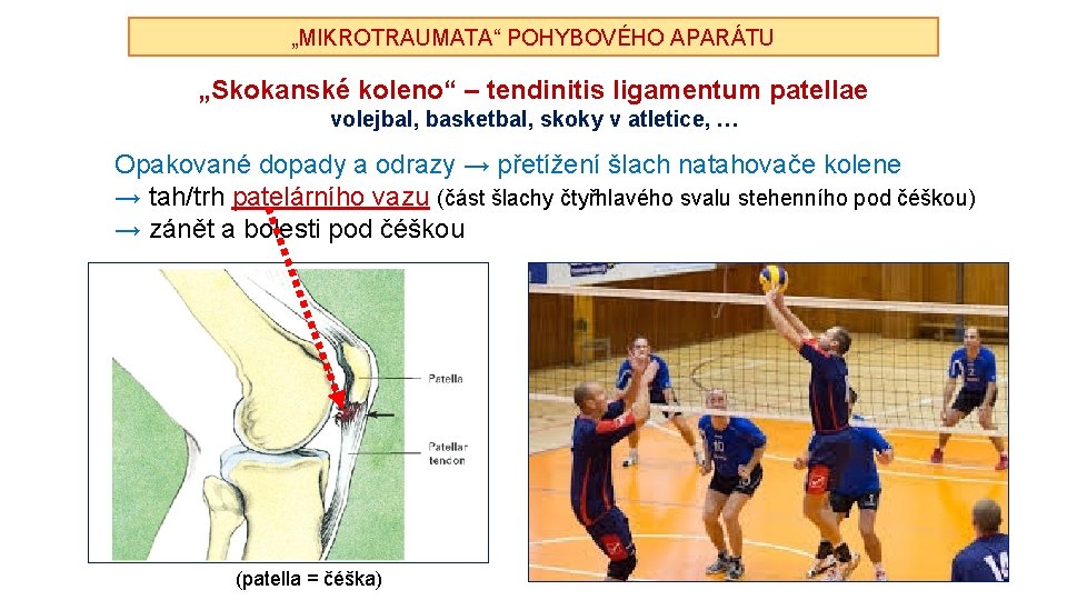 „MIKROTRAUMATA“ POHYBOVÉHO APARÁTU „Skokanské koleno“ – tendinitis ligamentum patellae volejbal, basketbal, skoky v atletice,