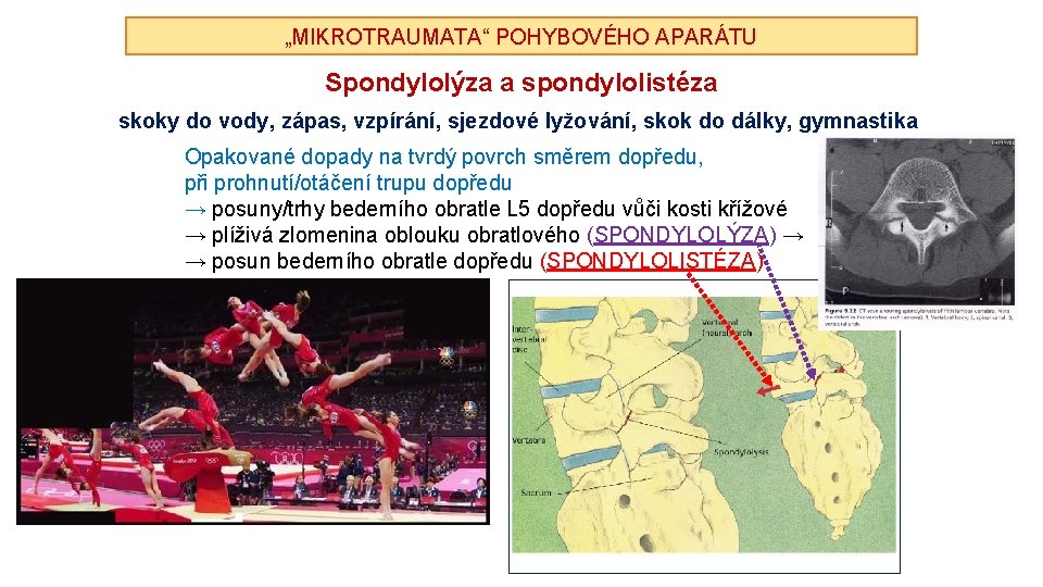 „MIKROTRAUMATA“ POHYBOVÉHO APARÁTU Spondylolýza a spondylolistéza skoky do vody, zápas, vzpírání, sjezdové lyžování, skok