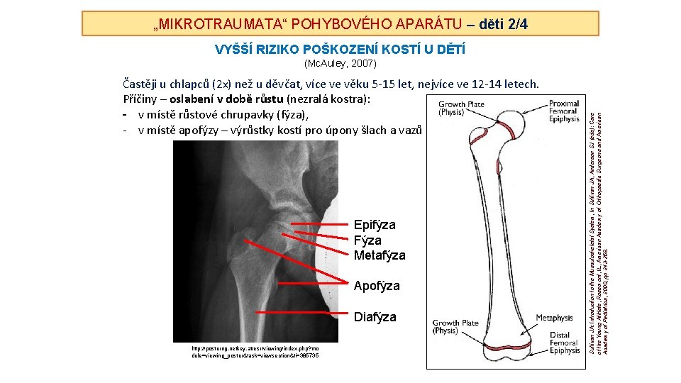 „MIKROTRAUMATA“ POHYBOVÉHO APARÁTU – děti 2/4 VYŠŠÍ RIZIKO POŠKOZENÍ KOSTÍ U DĚTÍ Častěji u