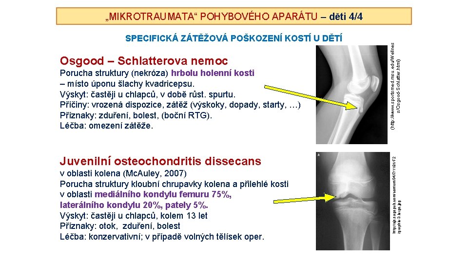 Osgood – Schlatterova nemoc Porucha struktury (nekróza) hrbolu holenní kosti – místo úponu šlachy