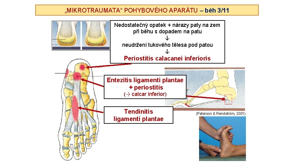 „MIKROTRAUMATA“ POHYBOVÉHO APARÁTU – běh 3/11 Nedostatečný opatek + nárazy paty na zem při