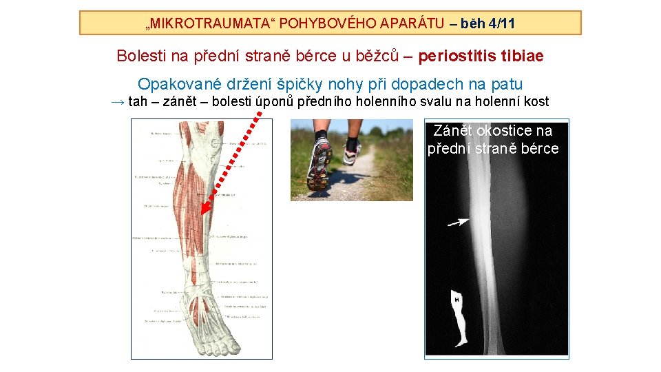 „MIKROTRAUMATA“ POHYBOVÉHO APARÁTU – běh 4/11 Bolesti na přední straně bérce u běžců –