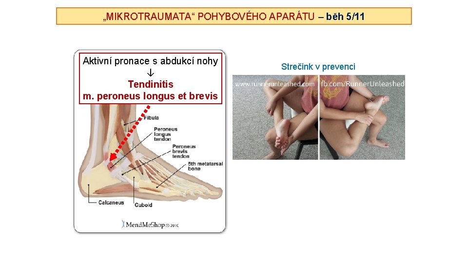 „MIKROTRAUMATA“ POHYBOVÉHO APARÁTU – běh 5/11 Aktivní pronace s abdukcí nohy ↓ Tendinitis m.