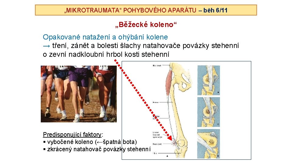 „MIKROTRAUMATA“ POHYBOVÉHO APARÁTU – běh 6/11 „Běžecké koleno“ Opakované natažení a ohýbání kolene →