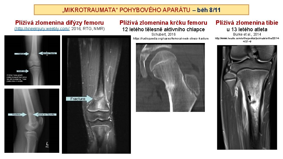 „MIKROTRAUMATA“ POHYBOVÉHO APARÁTU – běh 8/11 Plíživá zlomenina difýzy femoru Plíživá zlomenina krčku femoru