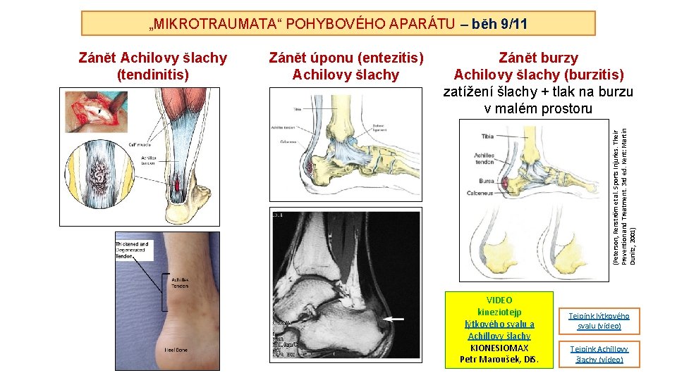 „MIKROTRAUMATA“ POHYBOVÉHO APARÁTU – běh 9/11 Zánět úponu (entezitis) Achilovy šlachy Zánět burzy Achilovy