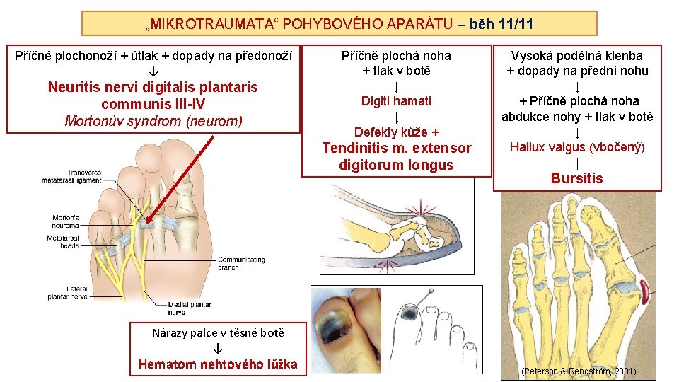 „MIKROTRAUMATA“ POHYBOVÉHO APARÁTU – běh 11/11 Příčné plochonoží + útlak + dopady na předonoží