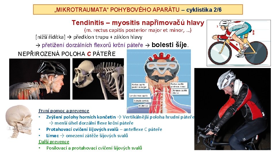 „MIKROTRAUMATA“ POHYBOVÉHO APARÁTU – cyklistika 2/6 Tendinitis – myositis napřimovačů hlavy (m. rectus capitis