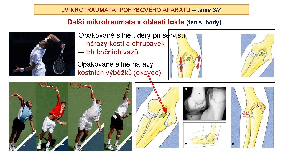 „MIKROTRAUMATA“ POHYBOVÉHO APARÁTU – tenis 3/7 Další mikrotraumata v oblasti lokte (tenis, hody) Opakované