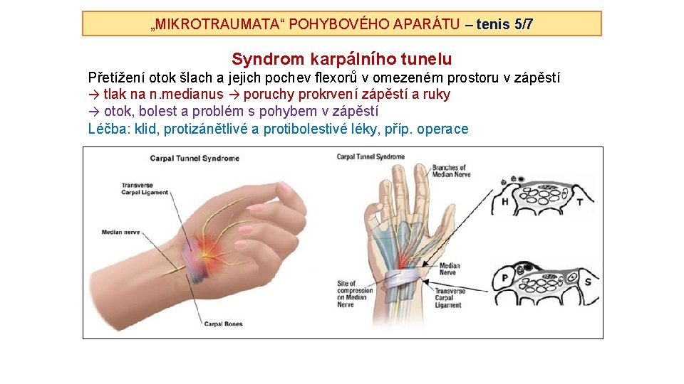 „MIKROTRAUMATA“ POHYBOVÉHO APARÁTU – tenis 5/7 Syndrom karpálního tunelu Přetížení otok šlach a jejich