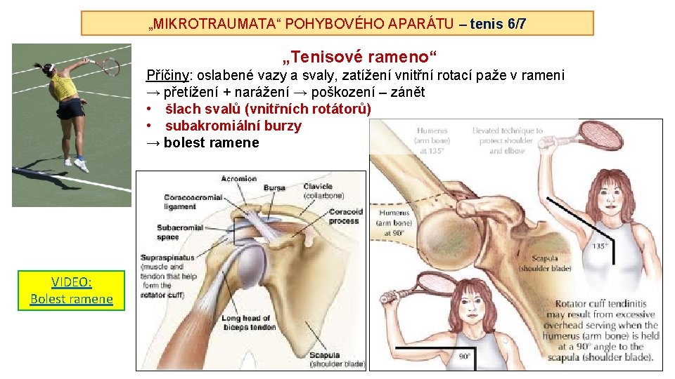 „MIKROTRAUMATA“ POHYBOVÉHO APARÁTU – tenis 6/7 „Tenisové rameno“ Příčiny: oslabené vazy a svaly, zatížení