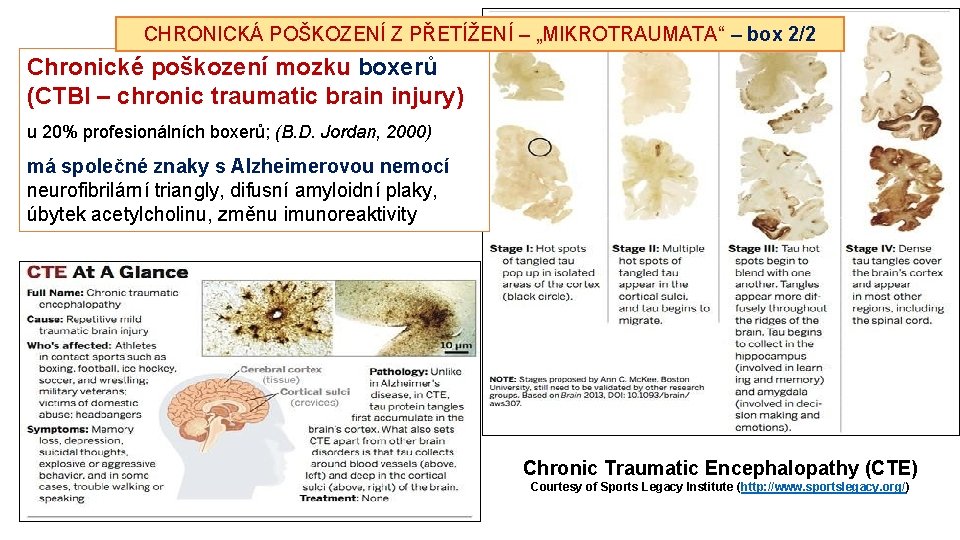 CHRONICKÁ POŠKOZENÍ Z PŘETÍŽENÍ – „MIKROTRAUMATA“ – box 2/2 Chronické poškození mozku boxerů (CTBI