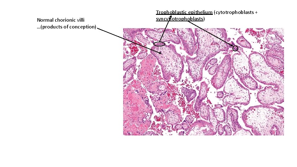 Normal chorionic villi …(products of conception) Trophoblastic epithelium (cytotrophoblasts + syncytiotrophoblasts) 