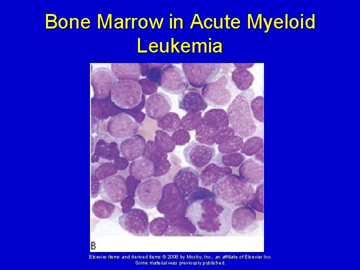 Bone Marrow in Acute Myeloid Leukemia Elsevier items and derived items © 2008 by